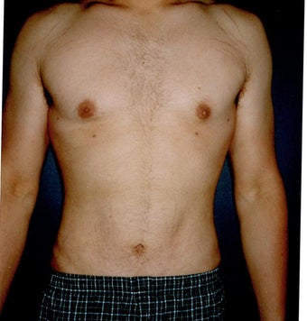 Vaser Liposuction after 921621