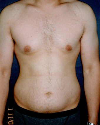 Vaser Liposuction before 921621