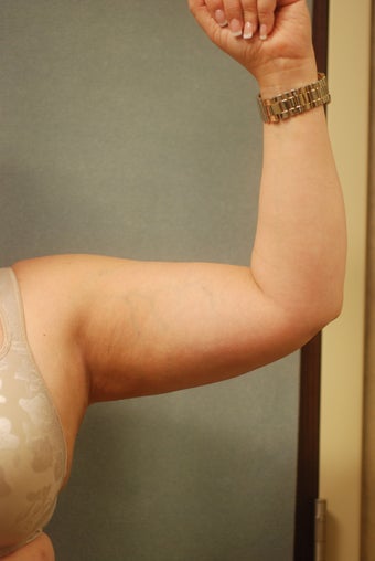 SmartLipo Arms after 356400