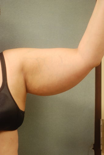 SmartLipo Arms before 356400