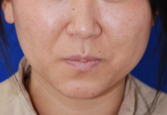 Botox Facial Contouring/Jawline Reduction before 307249