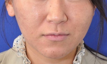 Botox Facial Contouring/Jawline Reduction after 307249