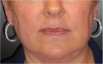 Juvederm after 686398