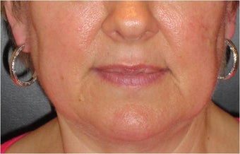 Juvederm before 686398