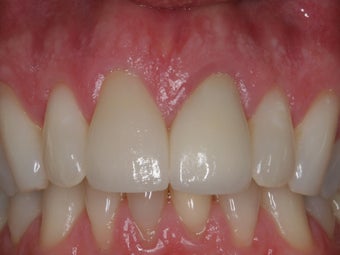 Anterior Crowns after 372792