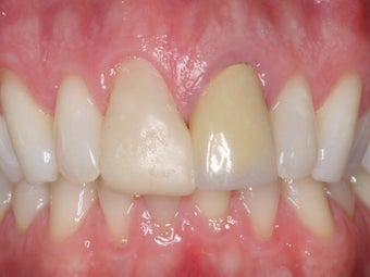 Anterior Crowns before 372792