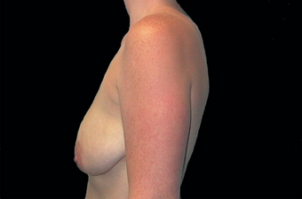 Breast augmentation 391337