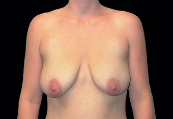 Breast augmentation before 391337