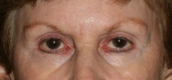 Restylane & Botox for eye rejuvenation before 1134413