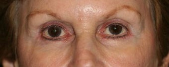 Restylane & Botox for eye rejuvenation after 1134413