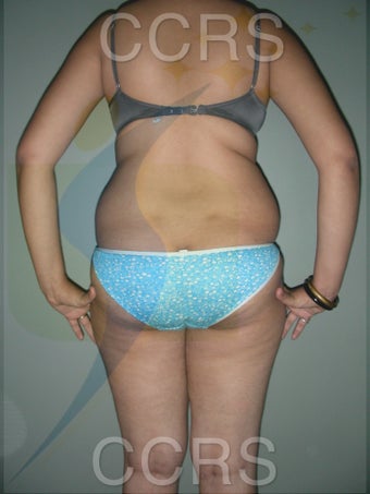 VASER Lipo - 25 yrs. old female (abdomen, back, flanks & thighs) 636081