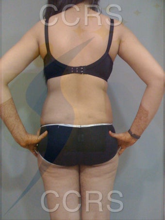 VASER Lipo - 25 yrs. old female (abdomen, back, flanks & thighs) 636081