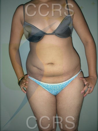 VASER Lipo - 25 yrs. old female (abdomen, back, flanks & thighs) before 636081