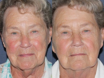 Before & After IPL Photo Facial before 806254