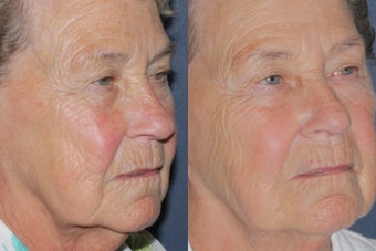 Before & After IPL Photo Facial 806254