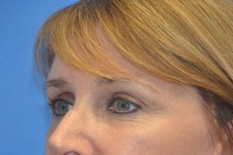Endoscopic Browlift, SMAS Facelift and Necklift, Chin Implant after 837360