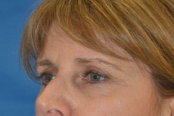 Endoscopic Browlift, SMAS Facelift and Necklift, Chin Implant before 837360