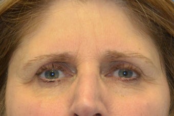Endoscopic Browlift, SMAS Facelift and Necklift, Chin Implant 837360