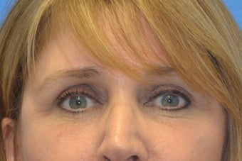 Endoscopic Browlift, SMAS Facelift and Necklift, Chin Implant 837360