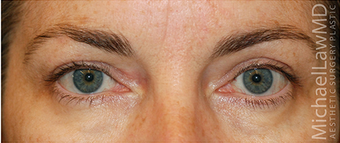 Eye Bag Surgery after 886816