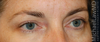 Eye Bag Surgery 886816