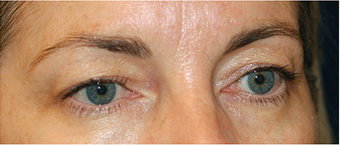 Eye Bag Surgery 886816