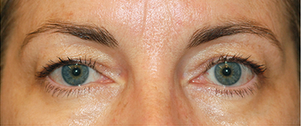 Eye Bag Surgery before 886816