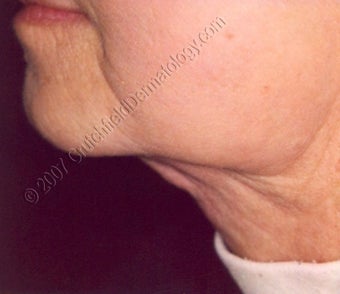 LipoDissolve injections to neck fat after 9740