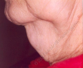 LipoDissolve injections to neck fat before 9740