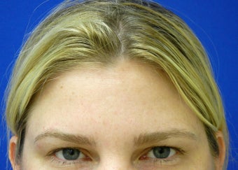 Glabellar Lines after 837787