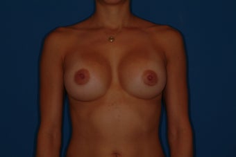 Breast Implant Revision after 347228