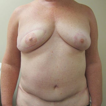 64-year-old female with right delayed DIEP flap breast reconstruction after 699002