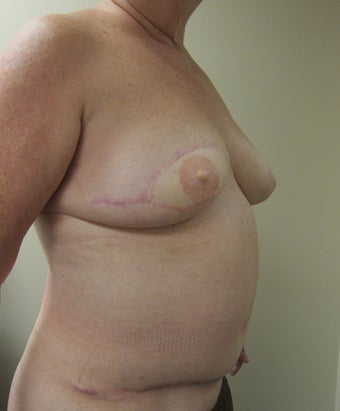 64-year-old female with right delayed DIEP flap breast reconstruction 699002