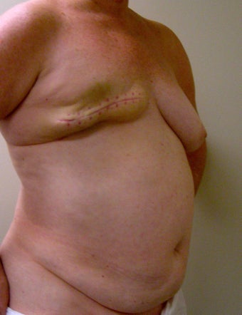 64-year-old female with right delayed DIEP flap breast reconstruction 699002
