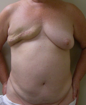 64-year-old female with right delayed DIEP flap breast reconstruction before 699002