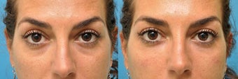 Tear Trough Fillers - Microcannula Technique before 579740