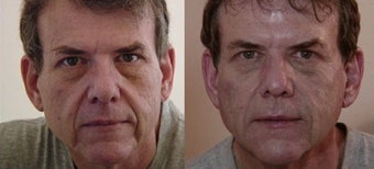 Dermal filler facial transformation before 44707