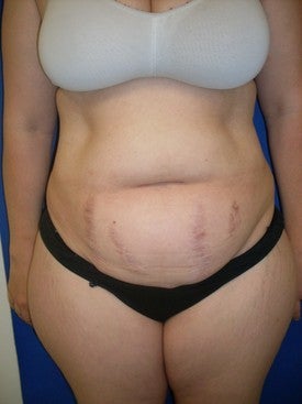 Laser Liposuction 561222
