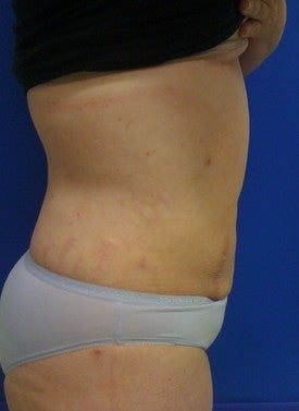 Laser Liposuction after 561222