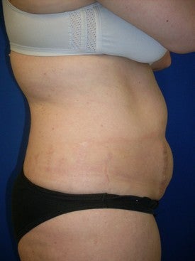 Laser Liposuction before 561222