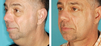 Facelift before 1205209