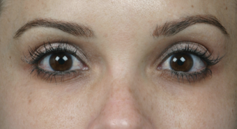Latisse for Eyelashes after 310724
