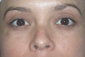 Latisse for Eyelashes before 310724