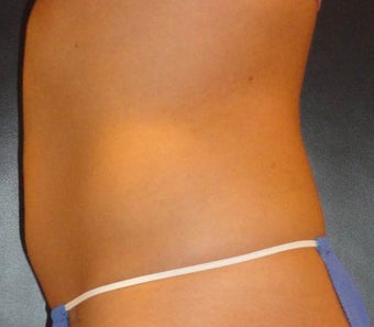 SmartLipo MPX 914561
