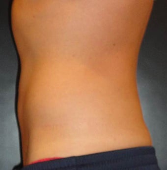 SmartLipo MPX 914561