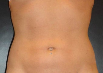 SmartLipo MPX after 914561