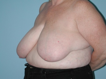 Underwent a Breast Reduction before 962877