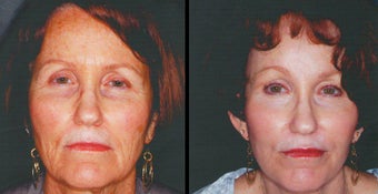 Laser Skin Resurfacing before 1247523
