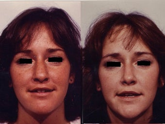 Rhinoplasty before 139103