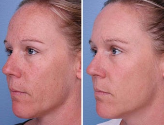 IPL for Brown Spots before 242556